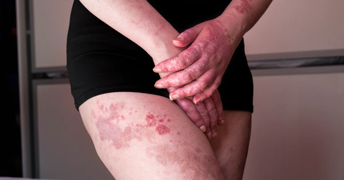 Lupus: síntomas, mitos y verdades de una enfermedad que imita a todas