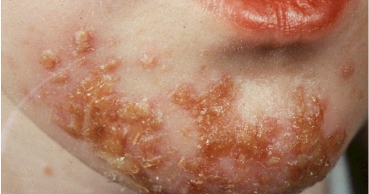Ministerio de Salud indica no se ha confirmado presencia de "bacteria carnívora" en RD